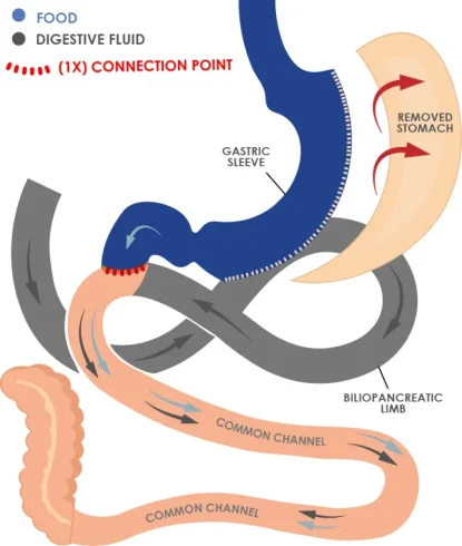 SADI-S Diagram
