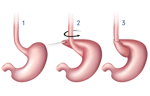 LES procedure diagram